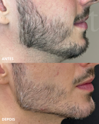 Resultado de paciente da Gioventù Clínica Boutique, em Ribeirão Preto