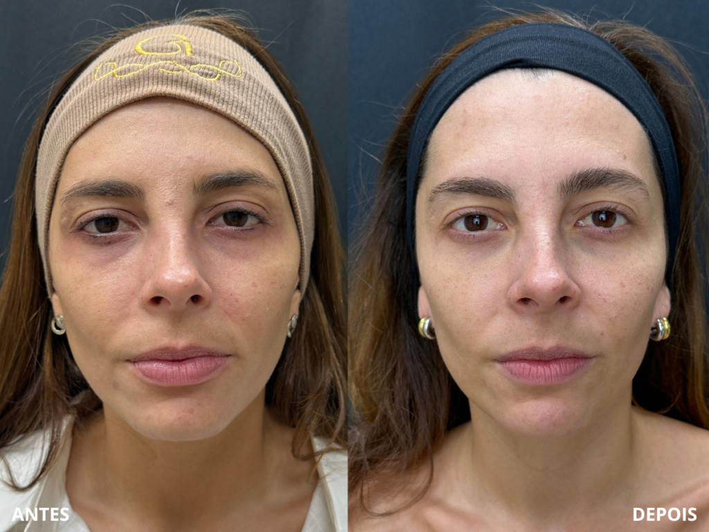 Resultado de paciente — Radiofrequência Facial